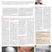 Decompressione discale con il laser: la tecnica Pldd